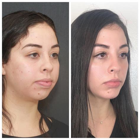 buccal fat reduction scottsdale|Tamplen Plastic Surgery – Buccal Fat Removal.